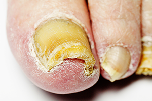 toenail-fungus-infection