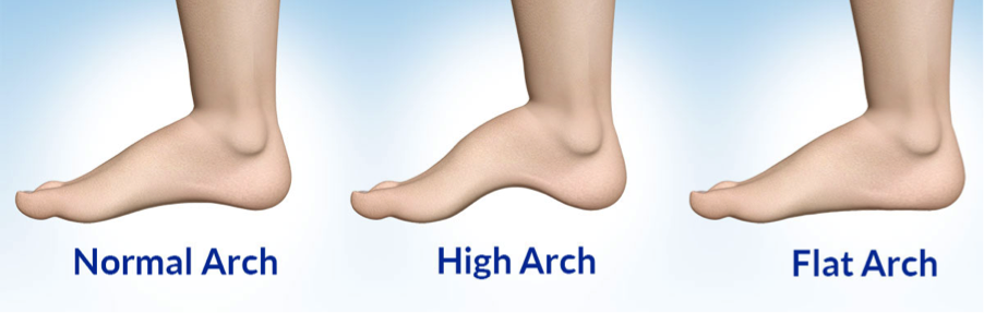 High Arches vs. Low Arches | Kintec: Footwear + Orthotics