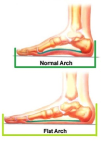 High Arch vs. Low Arch | Kintec: Footwear + Orthotics