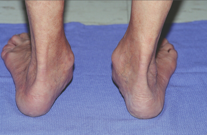 Flat feet deals in adults