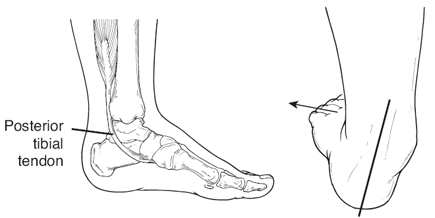 adult acquired flat feet