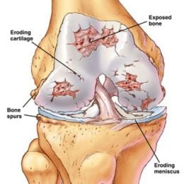 knee osteoarthritis