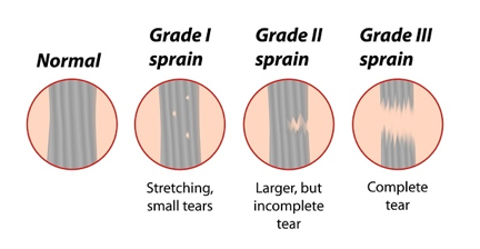 grade of sprain 2