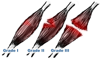 grade of sprain