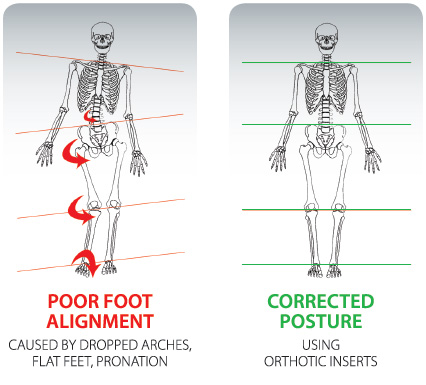 How To Treat Low Back Pain with Orthotics - MASS4D® Foot Orthotics