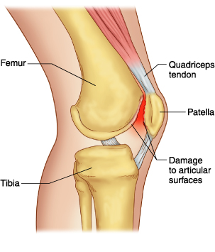 Patellar Tracking Disorder Braces