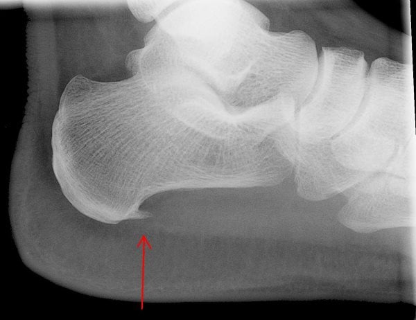 People tend to mix up heel spurs and plantar fasciitis as the symptoms can be similar. 