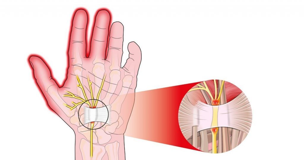 How to choose the best wrist and elbow braces